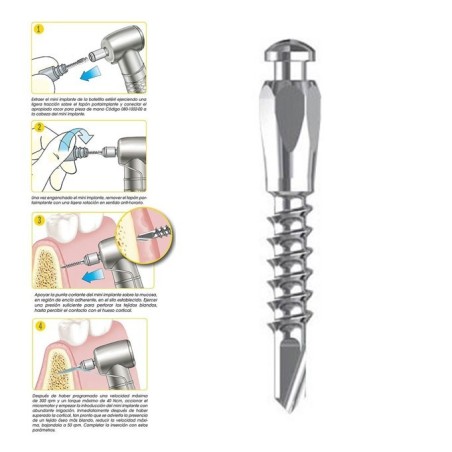 MINI IMPLANT ORTHODONTIQUE AUTOPERFORES Ø1,75 mm 1 Ud