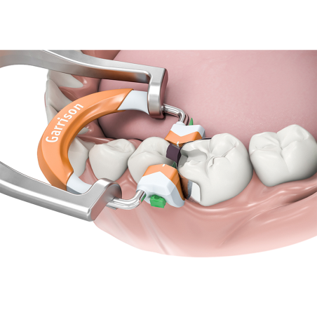 COMPOSI-THIGT 3D FUSION KIT